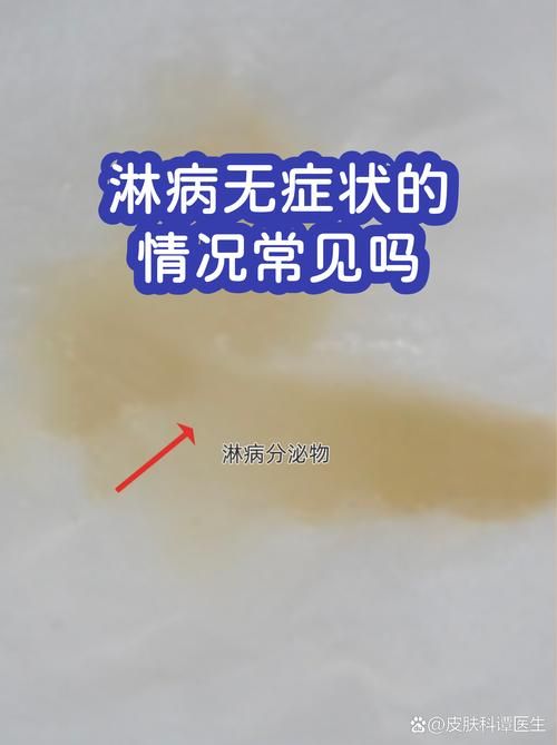 【全球增25例无症状感染者,无症状感染者的国家有多少】